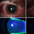 The Power of Continuous UV Light Exposure