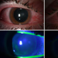 The Dangers of UV Light Exposure and How to Protect Yourself