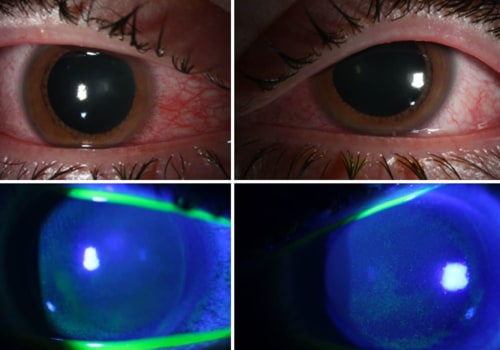 The Power of Continuous UV Light Exposure